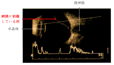 超音波断層法