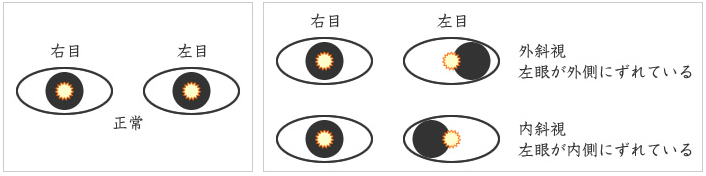 眼位検査(斜視検査)