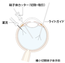 硝子体手術