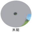 単焦点眼内レンズ 末期