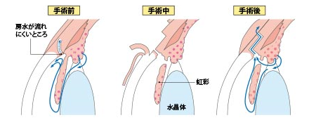 線維柱帯切除術（トラベクレクトミー）