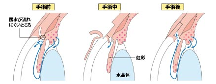 線維柱帯切開術（トラベクトーム）