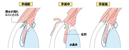 線維柱帯切開術(トラベクトーム)