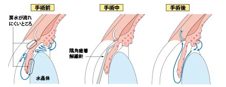 隅角癒着解離術 