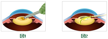 通常の白内障手術と先進医療の多焦点眼内レンズの白内障手術