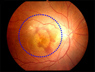 加齢黄斑変性症
