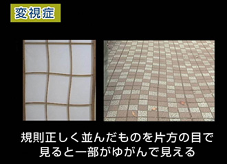 手術について 変視症