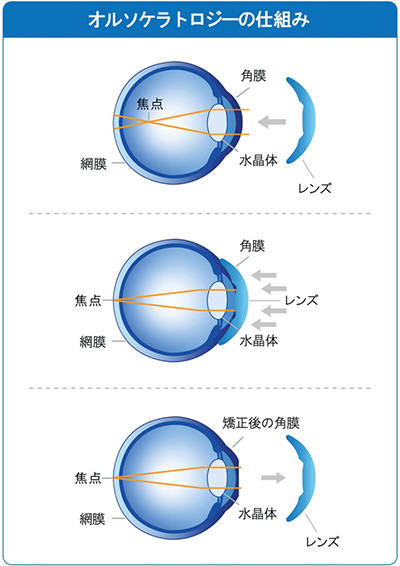 オルソケラトロジーとは